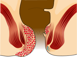 afbeelding Graad IV: Aambeien die zo groot zijn dat ze buiten de anus hangen en niet manueel teruggeduwd kunnen worden. afbeelding Graad IV: Aambeien die zo groot zijn dat ze buiten de anus hangen en niet manueel teruggeduwd kunnen worden.