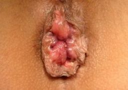 foto: Graad II: Vaak bloedende aambeien die na de ontlasting buiten de anus verschijnen, maar die ook vaak vanzelf weer teruggaan foto Graad II: Vaak bloedende aambeien die na de ontlasting buiten de anus verschijnen, maar die ook vaak vanzelf weer teruggaan.