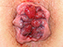 Graad IV: Aambeien die zo groot zijn dat ze buiten de anus hangen en niet manueel teruggeduwd kunnen worden. Graad IV: Aambeien die zo groot zijn dat ze buiten de anus hangen en niet manueel teruggeduwd kunnen worden.