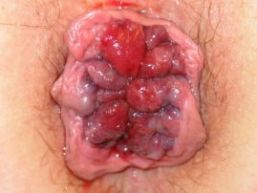 foto Graad IV: Aambeien die zo groot zijn dat ze buiten de anus hangen en niet manueel teruggeduwd kunnen worden. foto Graad IV: Aambeien die zo groot zijn dat ze buiten de anus hangen en niet manueel teruggeduwd kunnen worden.