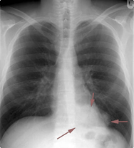 longontsteking foto x ray behandelen en symptomen. Besmettelijk?