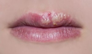 Haalbaarheid Afbreken Besmetten Koortslip behandelen: 8 tips wat te doen bij herpes lip | A.Vogel