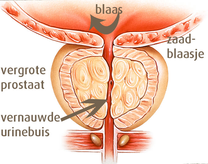 Hoe ziet een vergrote prostaat eruit? prostaatklachten, veel en vaak plassen